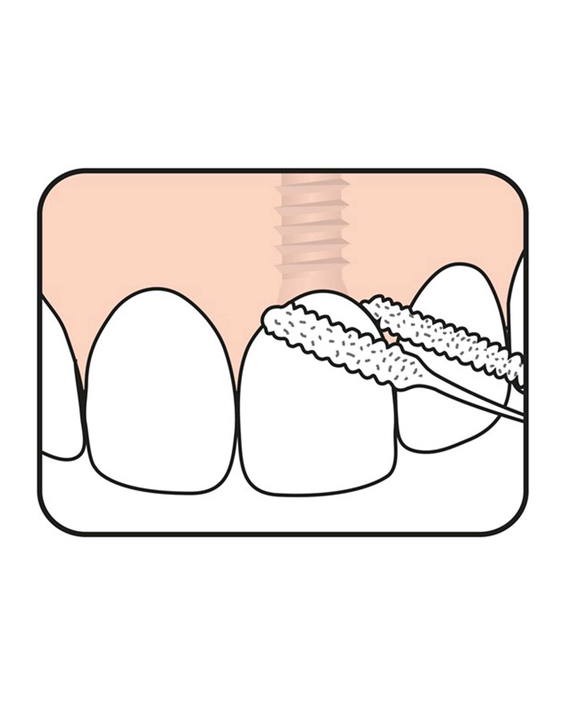 مسواک بین دندانی ته په Bridge and Implant بسته 30 عددی