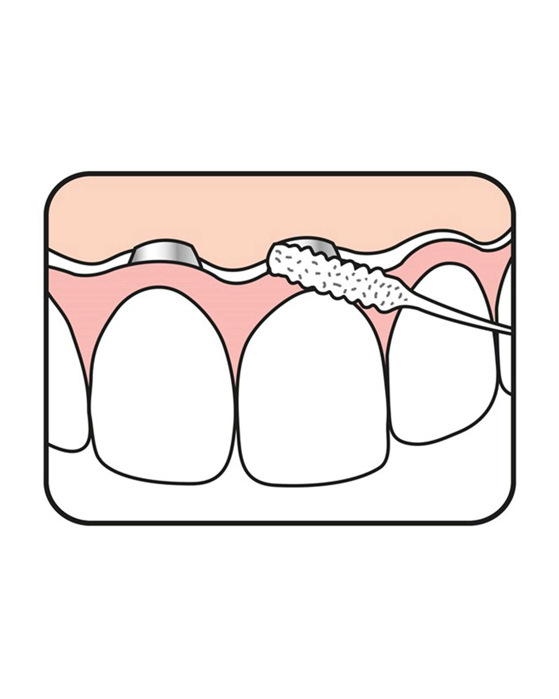 مسواک بین دندانی ته په Bridge and Implant بسته 30 عددی